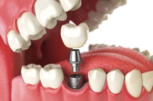 consider Dental Implants in dubai