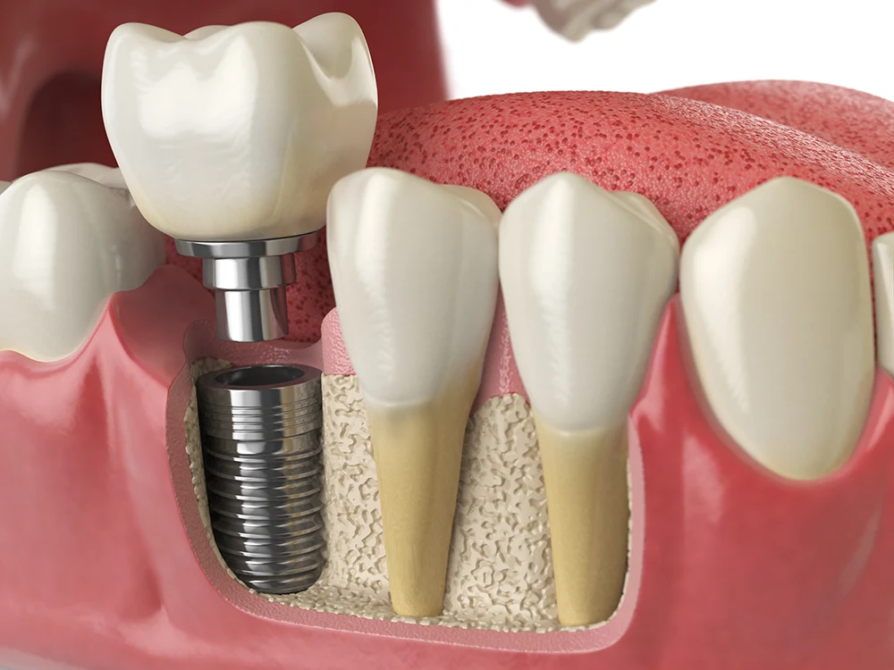 The Untold Secret To Mastering cost of smile transformation In Just 3 Days