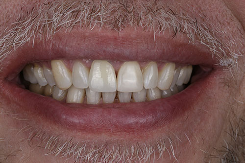 01_After ortho_crown_composite