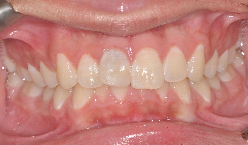 01_Before-Aligners1