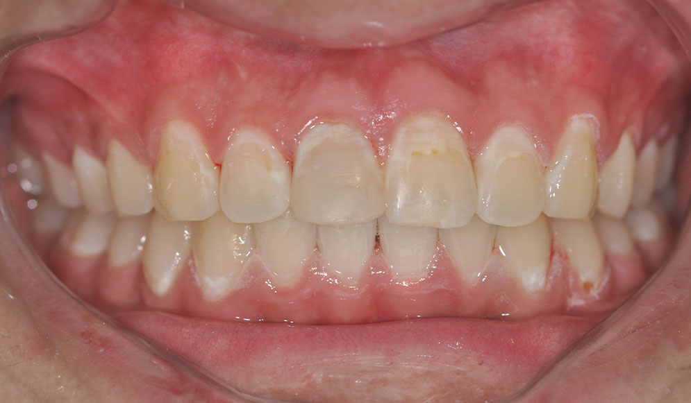 02_After-Aligners1