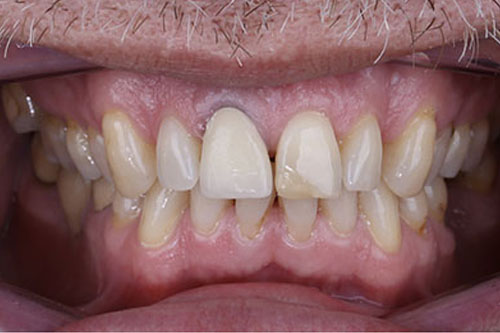 02_Before ortho_crown_composite