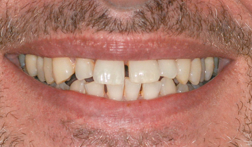 03_Before-Aligners-2