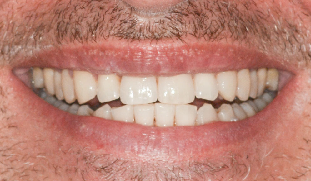 04_After-Aligners-2