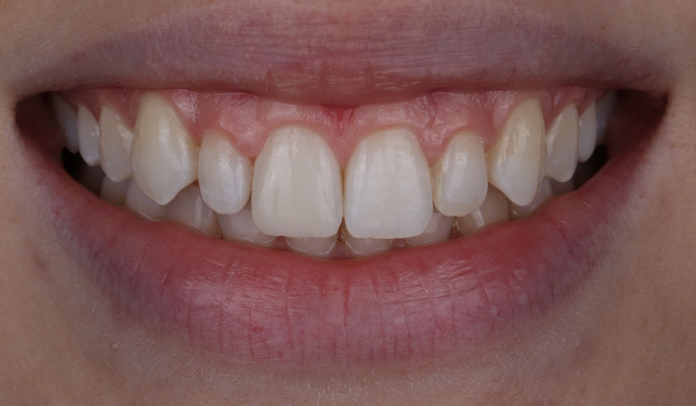 Whitening-After1