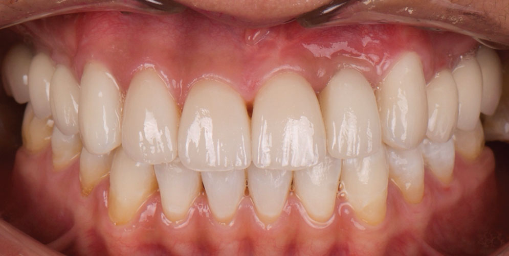 01_After-Implant