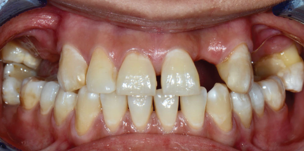 01_Before-Implant