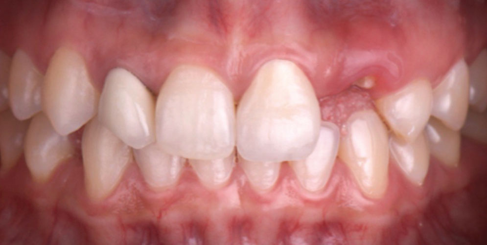 02_Before-Implant