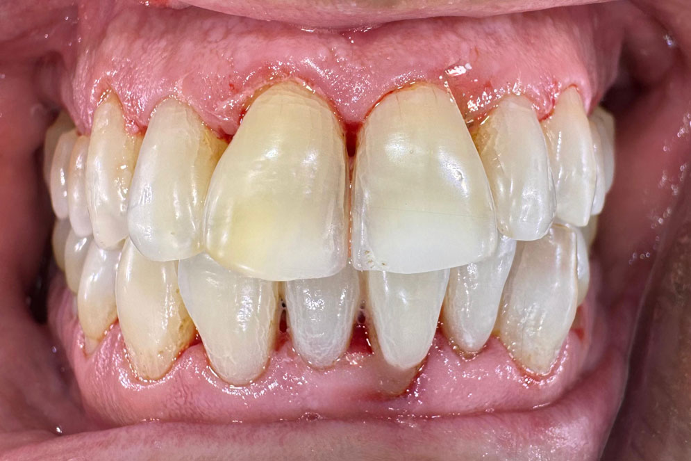 SC-Teeth-Cleaning-After1