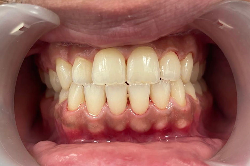 SC-Teeth-Cleaning-After2