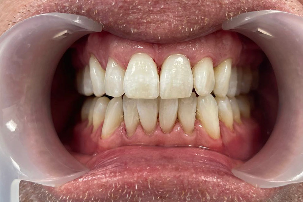 SC-Teeth-Cleaning-After3