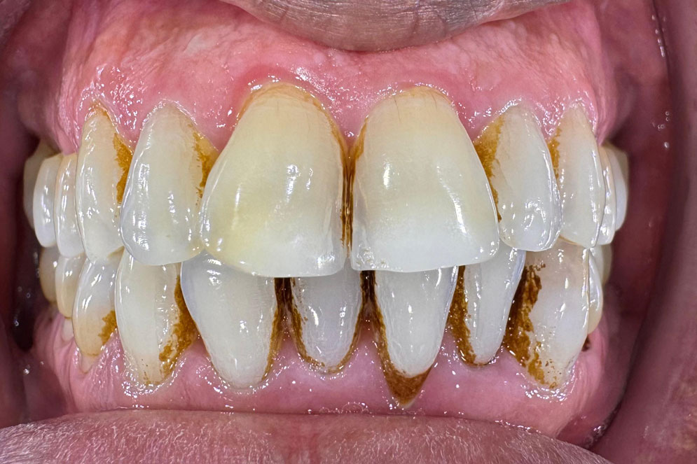 SC-Teeth-Cleaning-Before1