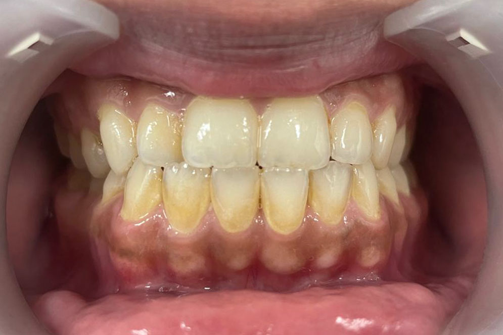 SC-Teeth-Cleaning-Before2