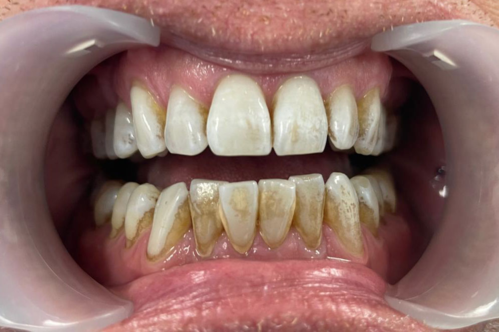 SC-Teeth-Cleaning-Before3