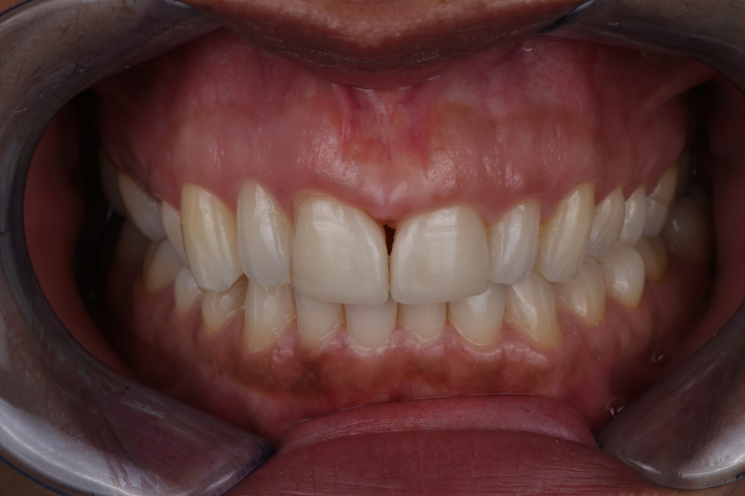 01_Before veneers