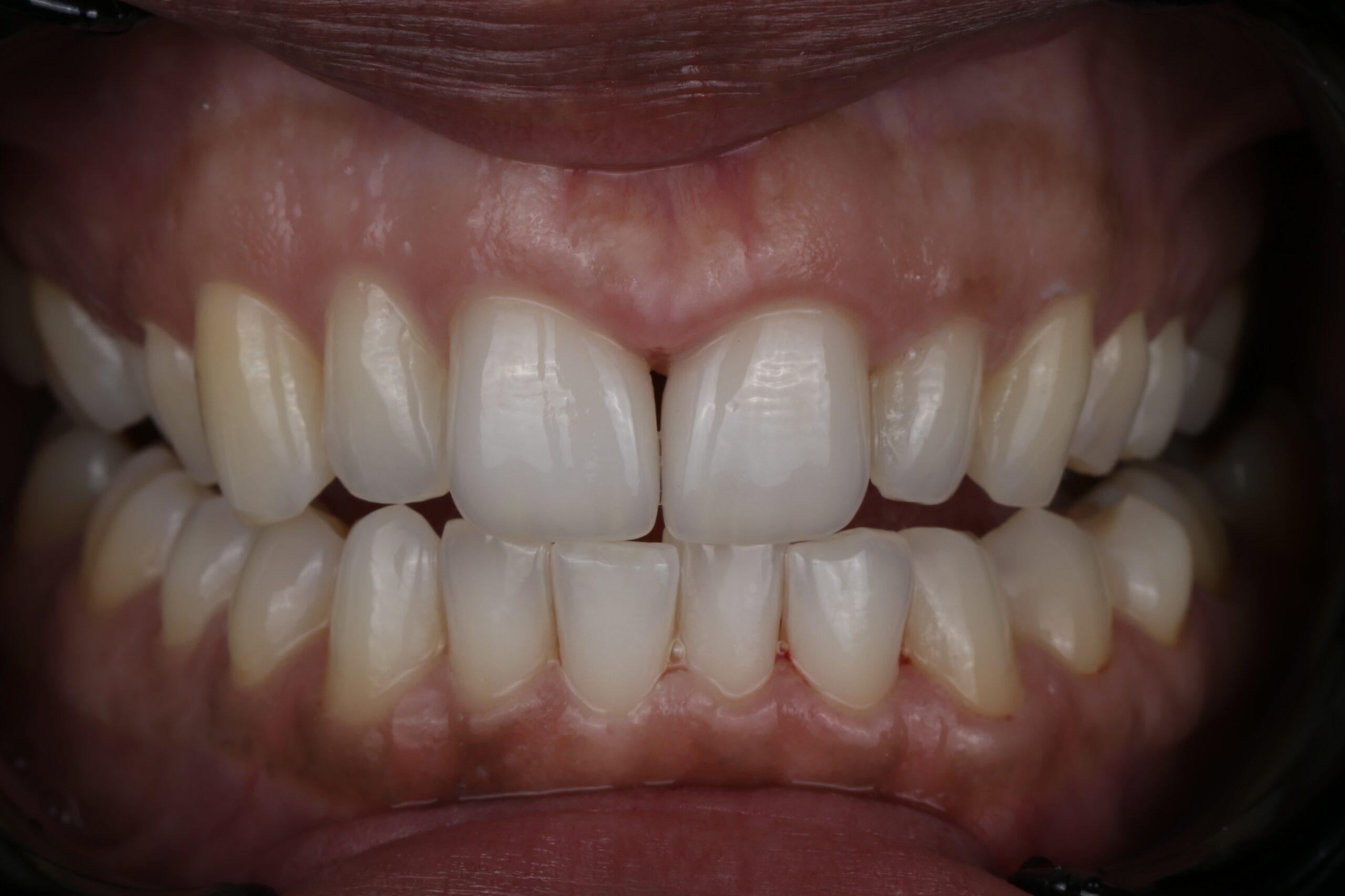 02_After veneers
