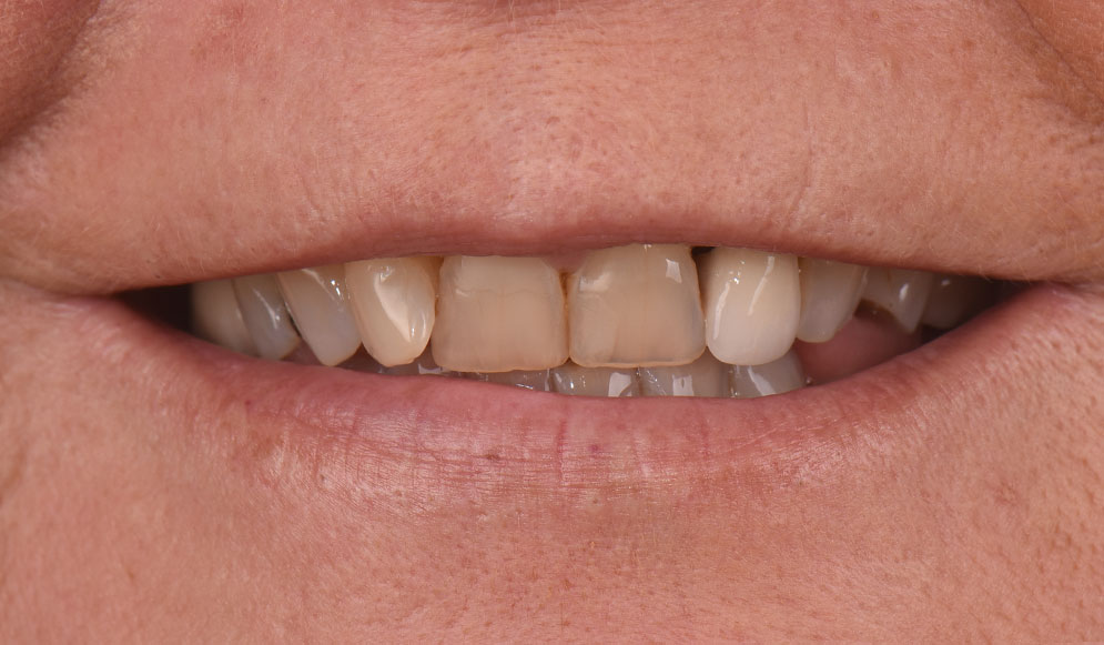 03_Before-veneers