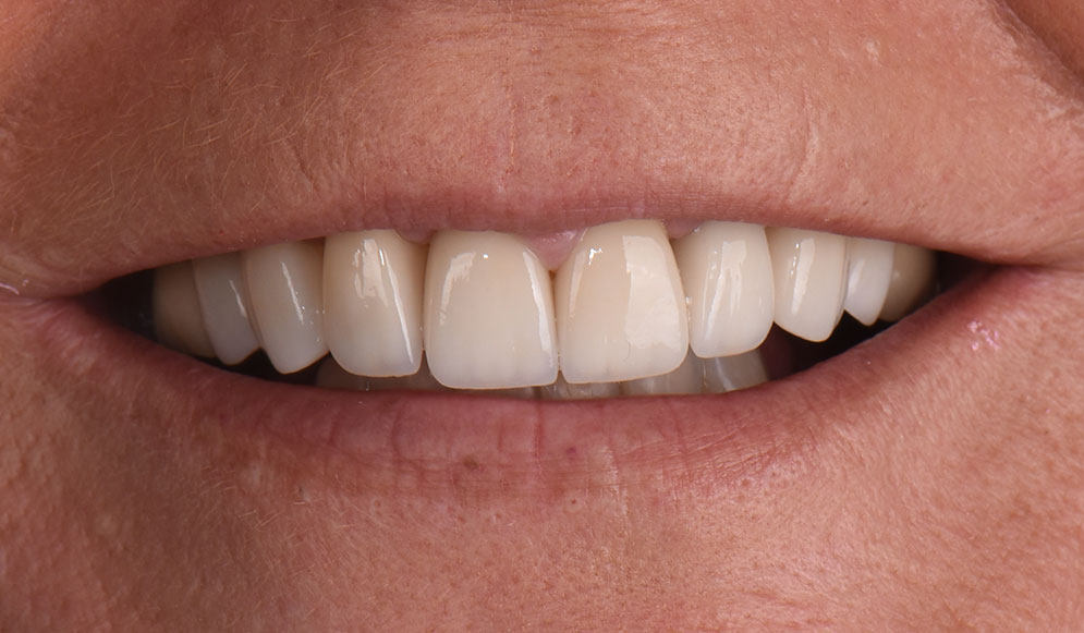 04_After-veneers